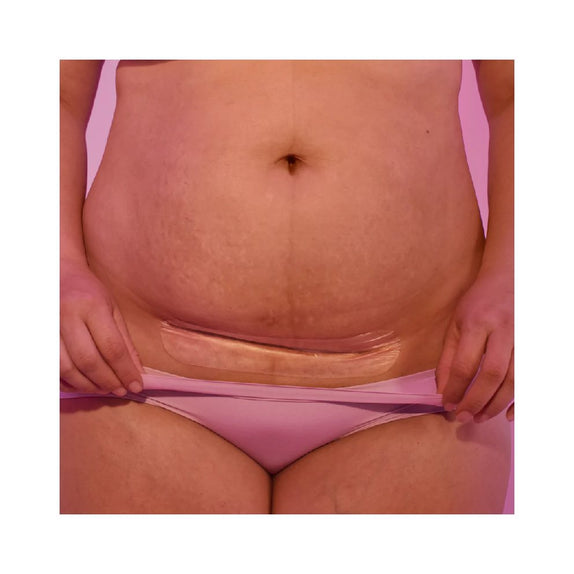 FridaMom C-Section Silicone Scar Patches - MamaApp